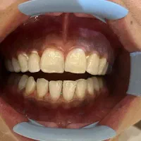 جرمگیری وبلیچینگ تخصصی دندان