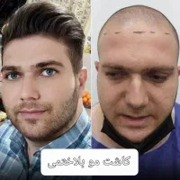 کاشت مو به صورت حرفه ای و با کیفیت عالی و تضمینی|خدمات آرایشگری و زیبایی|پارس‌آباد, |دیوار