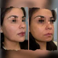 فیلر ژل بوتاکس|خدمات زیبایی و سلامت|اصفهان, مهرآباد|دیوار
