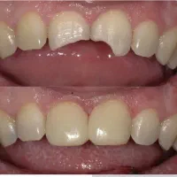 تخفیف ویژه انجام خدمات درمان وکامپوزیت و لمینت