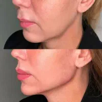 ژل وبوتاکس نخ فیلربادی توسط پزشک|خدمات آرایشگری و زیبایی|تهران, جمهوری|دیوار