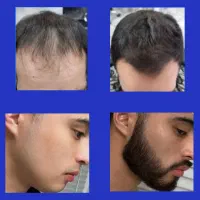 رویش تضمینی ریش و مو