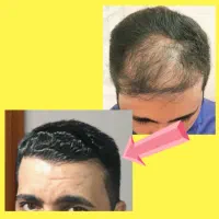 کاشت تضمینی و دائمی مو