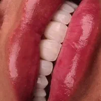 خدمات (دهان ،لمینیت،کامپوزیت