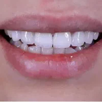 دندان مصنوعی ، دندانسازی ،طرح لمینت