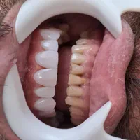 کامپوزیت دندان|خدمات آرایشگری و زیبایی|نورآباد, |دیوار