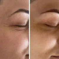کلاژن هیدرولیز شده