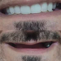 دندان مصنوعی پروتز متحرک.دندانسازی