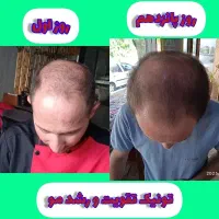 پک ریزش مو برای اولین بار در ایران|آرایشی، بهداشتی، درمانی|قم, چهار مردان|دیوار