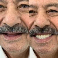 دندان، دندان مصنوعی،دندانسازی،پروتز مصنوعی،اقساطی