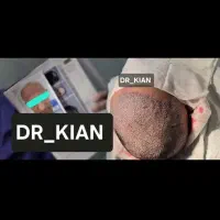 کاشت مو / کاشت ریش