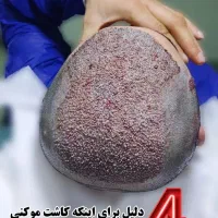 کاشت موی طبیعی|خدمات آرایشگری و زیبایی|شیراز, قدوسی شرقی|دیوار