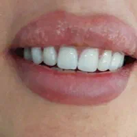 دندانسازی خیریه طرح لمینت|خدمات آرایشگری و زیبایی|مشهد, عامل|دیوار