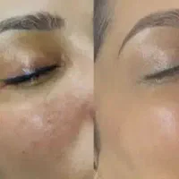 پی آرپی prp مزوتراپی مزونیدلینگ بوتاکس فشیال آنزیم|خدمات زیبایی و سلامت|تهران, دردشت|دیوار