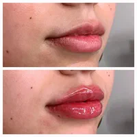 تزریق ژل بوتاکس مزو جوانساز|خدمات آرایشگری و زیبایی|وحیدیه, |دیوار