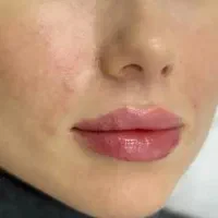 مدل فیلر کل صورت ،ژل لب، چونه،گونه،زاویه فک|خدمات آرایشگری و زیبایی|مشهد, هنرستان|دیوار