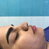جراحی بینی|خدمات آرایشگری و زیبایی|قائم‌شهر, |دیوار