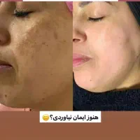 جوانسازی پوست|خدمات آرایشگری و زیبایی|گنبد کاووس, |دیوار