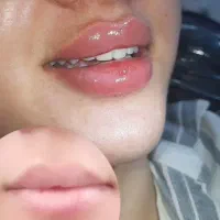 تخفیف ویژه،اموزش تزریقات ژل،فیلرو بوتاکس|خدمات آموزشی|تهران, دریاچه شهدای خلیج فارس|دیوار