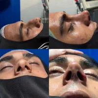 رینوپلاستی جراحی بینی ۳۸ تومن فقط برای شنبه