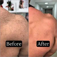 لیزر|خدمات آرایشگری و زیبایی|تهران, تهرانپارس شرقی|دیوار