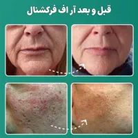 هایفوتراپی و آر اف ۷بعدی اولترا|خدمات آرایشگری و زیبایی|قم, زینبیه|دیوار