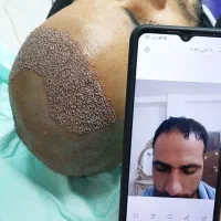 تخفیف ویژه کاشت مو و ابرو|خدمات آرایشگری و زیبایی|کرمانشاه, |دیوار