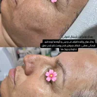فیشال و پاکسازی صورت|خدمات آرایشگری و زیبایی|شیراز, شهرک فرزانگان|دیوار