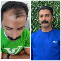 کاشت تخصصی مو و ابرو