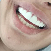 تخفیف کامپوزیت ونیر دندان|خدمات آرایشگری و زیبایی|اردبیل, |دیوار