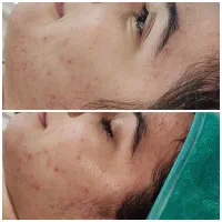 پاکسازی پوست،درمان منافذ باز،آکنه،تخلیه سر سیاه|خدمات آرایشگری و زیبایی|اهواز, سپیدار|دیوار