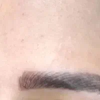 تخفیف ۵۰ درصدی فیبروز ابرو