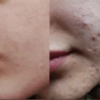 فیشیال پوست در کلینیک زیبایی