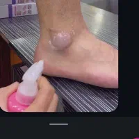 کرم ترک پا