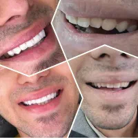 کامپوزیت دندان اقساطی|خدمات آرایشگری و زیبایی|قم, سراجه|دیوار