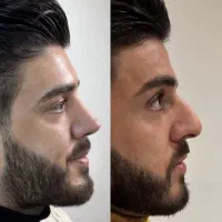 جراحی و رفع نواقص بینی توسط جراح گوش و حلق و بینی