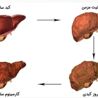 کبدچرب درمان شد*گیاهی*