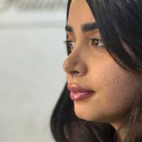 تخفیف ویژه بوتاکس،ژل لب‌،لیفت صورت بانخ توسط پزشک