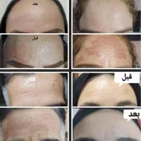 اموزش خدمات پلاسما کک ومک لک خال مزو کرمپودردائم|خدمات آرایشگری و زیبایی|قم, زنبیل آباد|دیوار