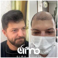 کاشت مو ابرو ریش تکنسین شیرازی|خدمات آرایشگری و زیبایی|قزوین, |دیوار