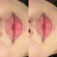 تزریقات ژل .بوتاکس .آنزیم .مزو ژل .مزوسر ضمانتی|خدمات آرایشگری و زیبایی|خرم‌آباد, |دیوار