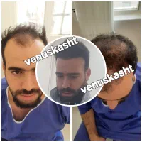 کاشت مو پر تراکم|خدمات آرایشگری و زیبایی|تهران, جردن|دیوار