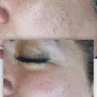 فیشیال درمانی تک جلسه ای|خدمات آرایشگری و زیبایی|مشهد, کشف|دیوار