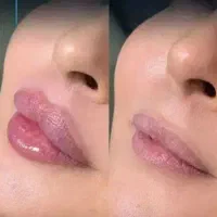 ژل بوتاکس و مزوتراپی ماندگاری بالا|خدمات زیبایی و سلامت|مشهد, طلاب|دیوار