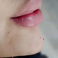 جشنواره فیلرو بوتاکس با قیمت باور نکردنی در مطب|خدمات آرایشگری و زیبایی|کرج, گوهردشت|دیوار