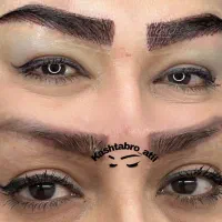 کاشت ابرو با روش جراحی و میکروکاشت