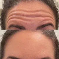 فرصت فوق‌العاده‌ی بوتاکس و فیلر