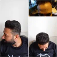 کاشت مو تضمینی واقساط|خدمات آرایشگری و زیبایی|اصفهان, محمودیه|دیوار