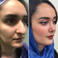جراحی زیبایی بینی اقساطی