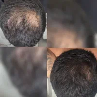 فقط 30 روز تا موهای رویایی